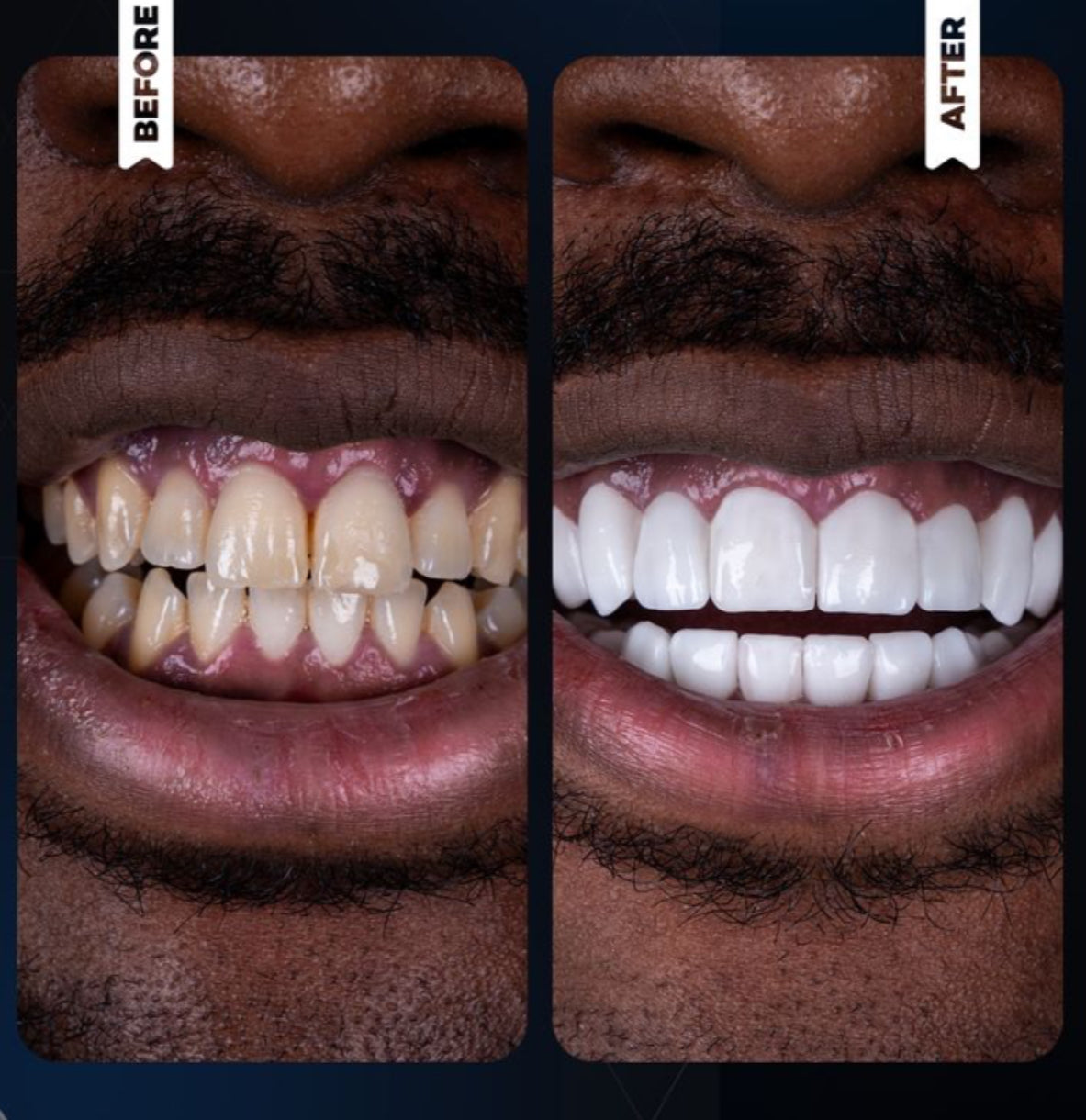 Crest 3D Whitening Professional Effects White Strips